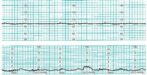 fetal monitoring strips practice|EFM Strip Practice Flashcards .